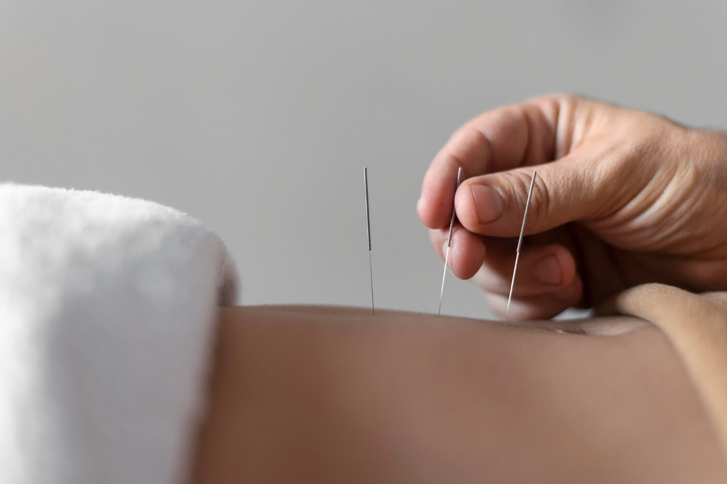 Cum se face acupunctura?