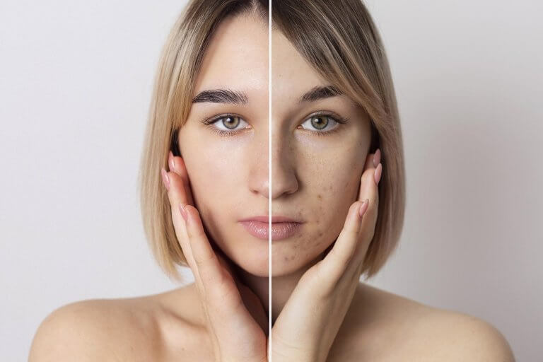 Acneea la adulți: cauze, rutina corectă, tratament și microneedling